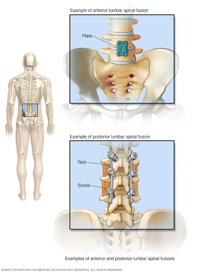 现时，医治脊椎受损问题，大都使用椎骨融合术（spinal fusion），利用骨骼移植（bone grafting）以及螺丝等硬件把两节椎骨连接起来。© Mayo Foundation for Medical Education and Research (MFMER)