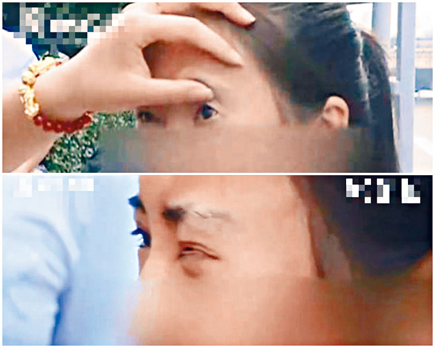 ■山西一女孩眼部整容失败，左眼睁不开闭不上。