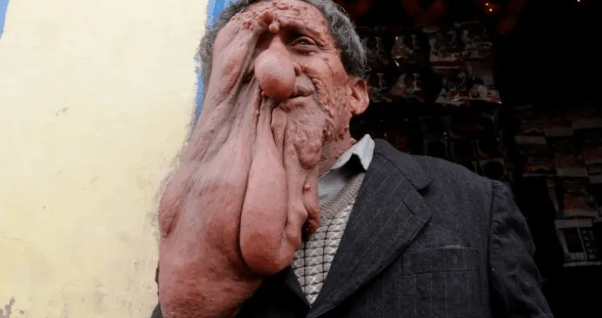 52歲男子達斯（Govardhan Das）因患有罕見疾病，右側臉頰看起來就像是融化了一樣。