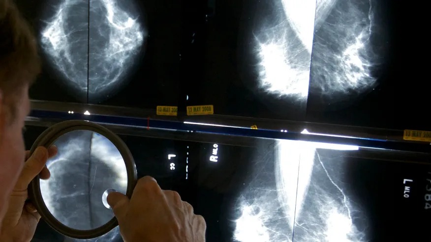  洛杉矶一名医疗人员在检查X光片中女士是否有乳癌。路透社