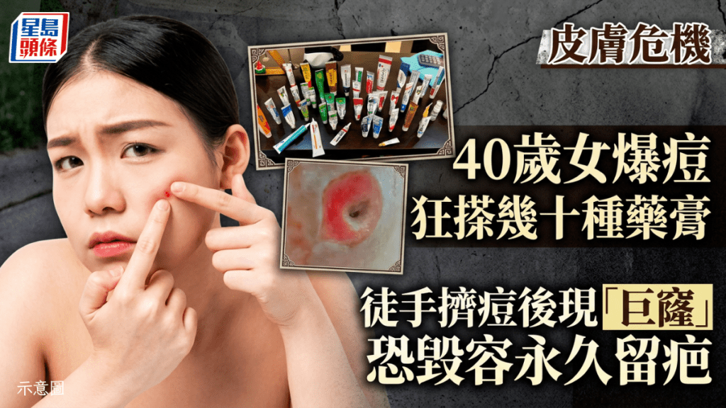 40岁女爆痘  狂搽几十种药膏  徒手挤痘后现「巨窿」  恐毁容永久留疤
