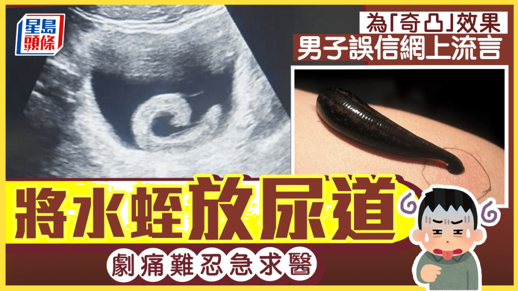 尿道塞水蛭︱23歲壯男為「奇特效果」做怪事  誤信網上資訊最終痛到面容扭曲