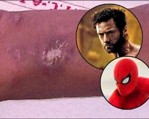 想變蜘蛛俠和狼人， 15歲少年多次讓蜘蛛咬，又將水銀注射到手臂，致手臂潰瘍。網圖