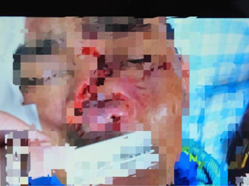 男事主被臉部及鼻子多處受傷。