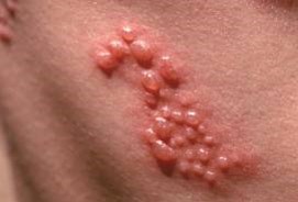 帶狀皰疹會在免疫力欠佳時發病。