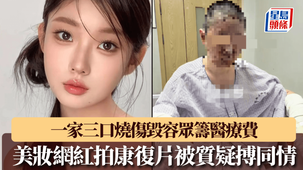 瀋陽27歲美妝網紅一家三口燒傷毀容，拍康復片眾籌被質疑搏同情。 