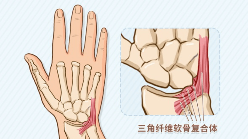 TFCC手腕三角纖維軟骨受傷。網上圖片