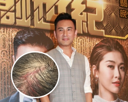 林文龍透露拍戲期間，頭部意外受傷。資料圖片