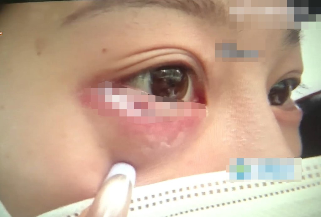 小呂手術失雙眼出現過敏，眼肚位置甚至出現流膿。1818黃金眼