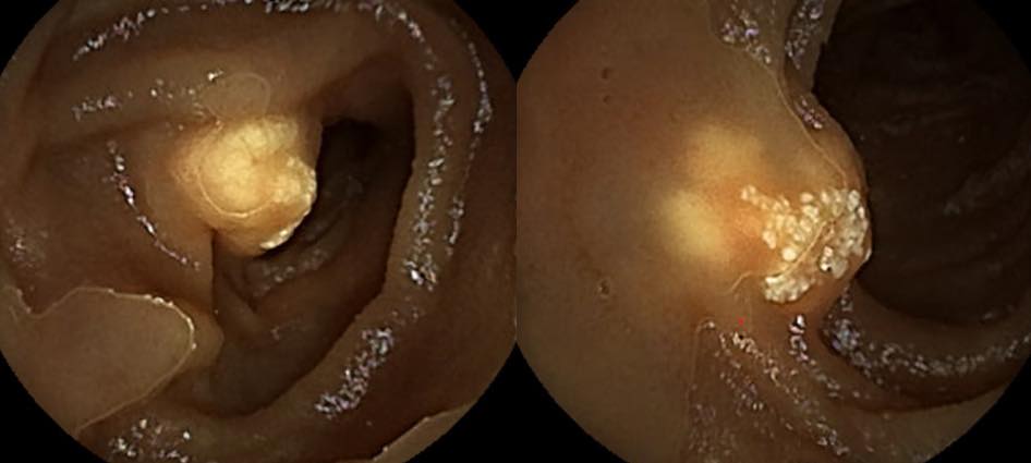 患者透過膠囊內視鏡發現的小腸腫瘤。（照片獲詹宜學醫生授權轉載）