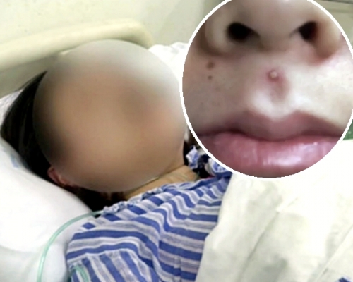 江蘇一名少女因擠人中位的暗瘡導致入院。網圖