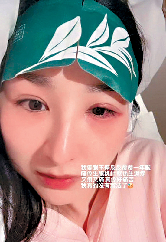 高Ling透露過去一年雙眼受濕疹困擾。