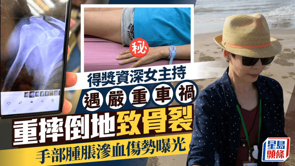 得獎資深女主持遇嚴重車禍    重摔倒地致骨裂手部腫脹滲血傷勢曝光令人疼心