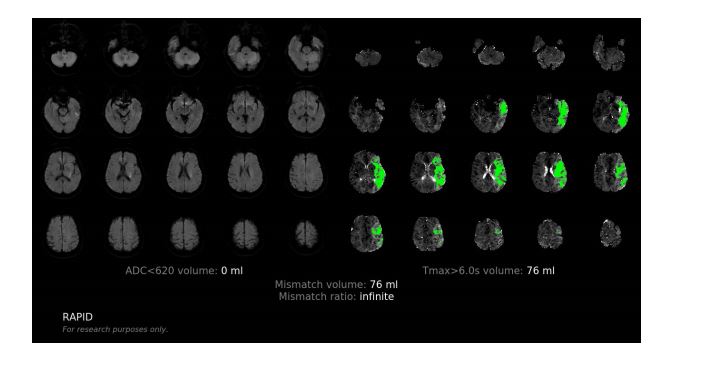 圖為人工智能系統的腦部圖像分析，綠色為低灌注的腦組織範圍（可拯救組織）。綠色範圍越大，術後改善病情的機會越大。養和圖片