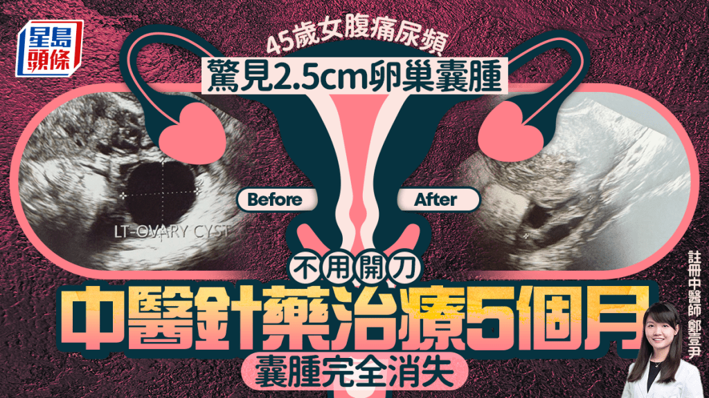 45歲女腹痛尿頻驚見2.5cm卵巢囊腫 中醫針藥治療5個月 不用開刀囊腫完全消失