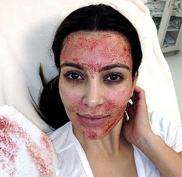 名媛金卡戴珊也做过“吸血鬼美容”。 Instagram
