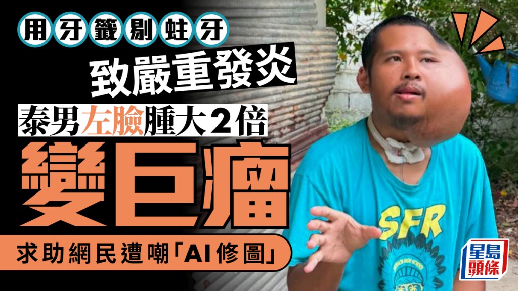 恐怖生活習慣｜泰男牙籤剔蛀牙釀嚴重發炎  左臉腫大2倍變巨瘤
