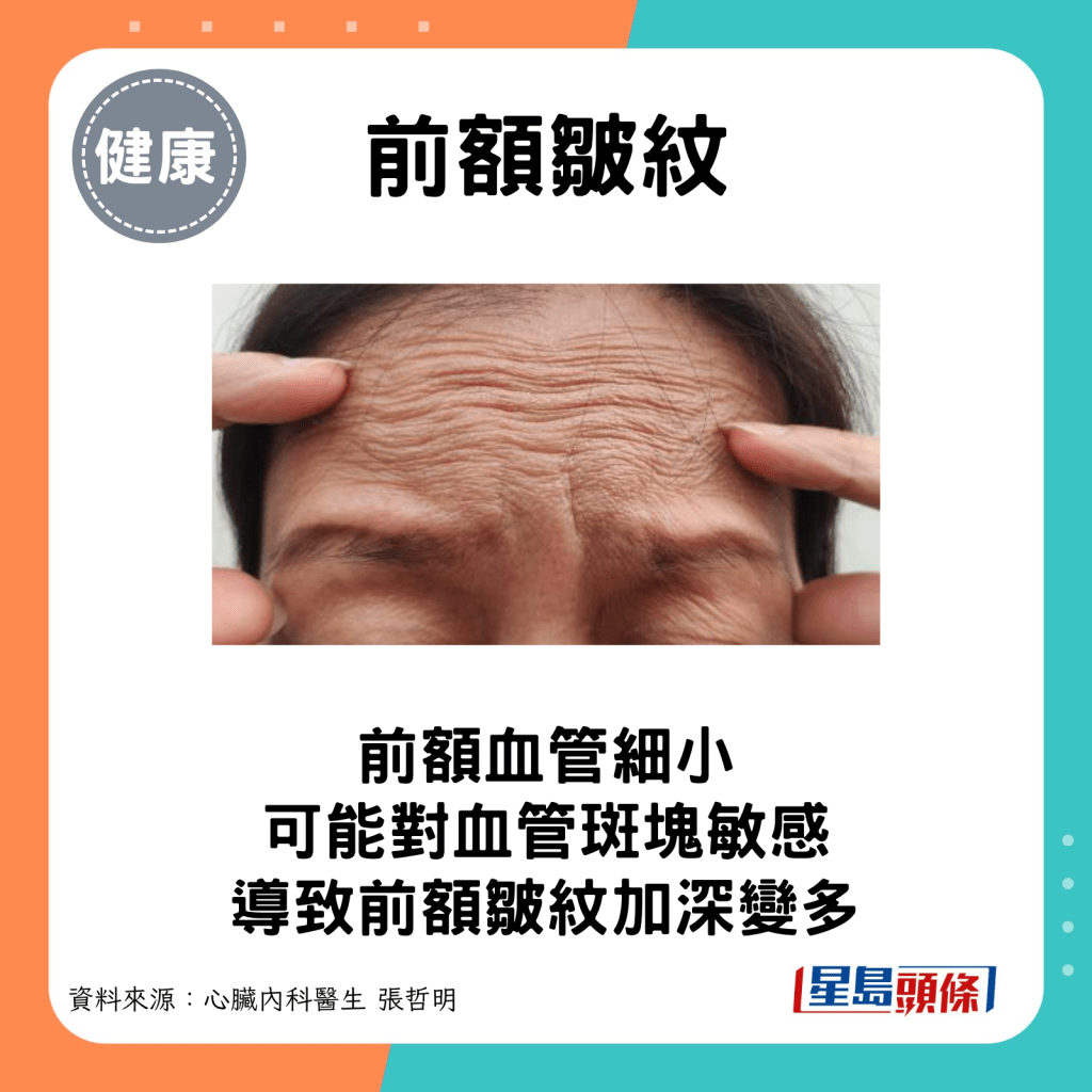 有研究發現，前額皺紋多且深的人士，死於心血管病的風險比沒皺紋的人士稍高。
