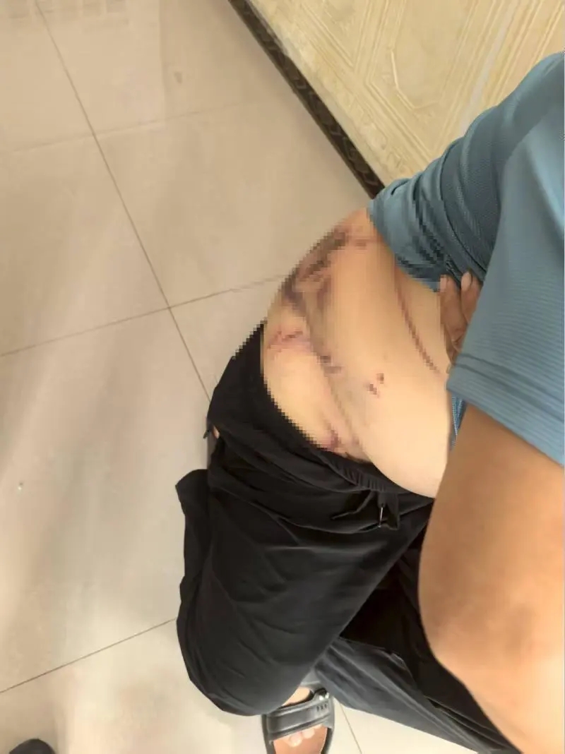 村民李先生自稱在山上務農時遭一隻老虎襲擊，導致背部、腰部受傷，衣物被撕爛。