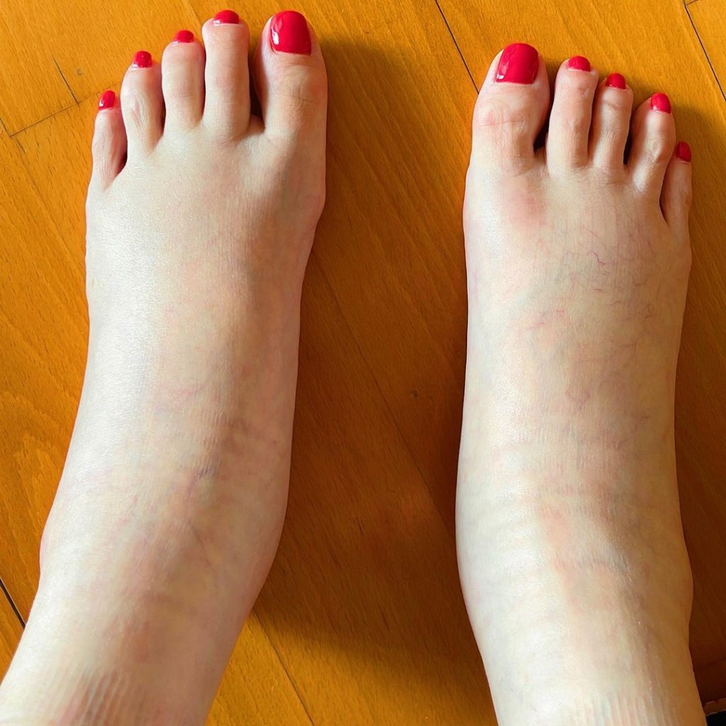 伍詠薇去年貼出腳腫相嚇親網民。