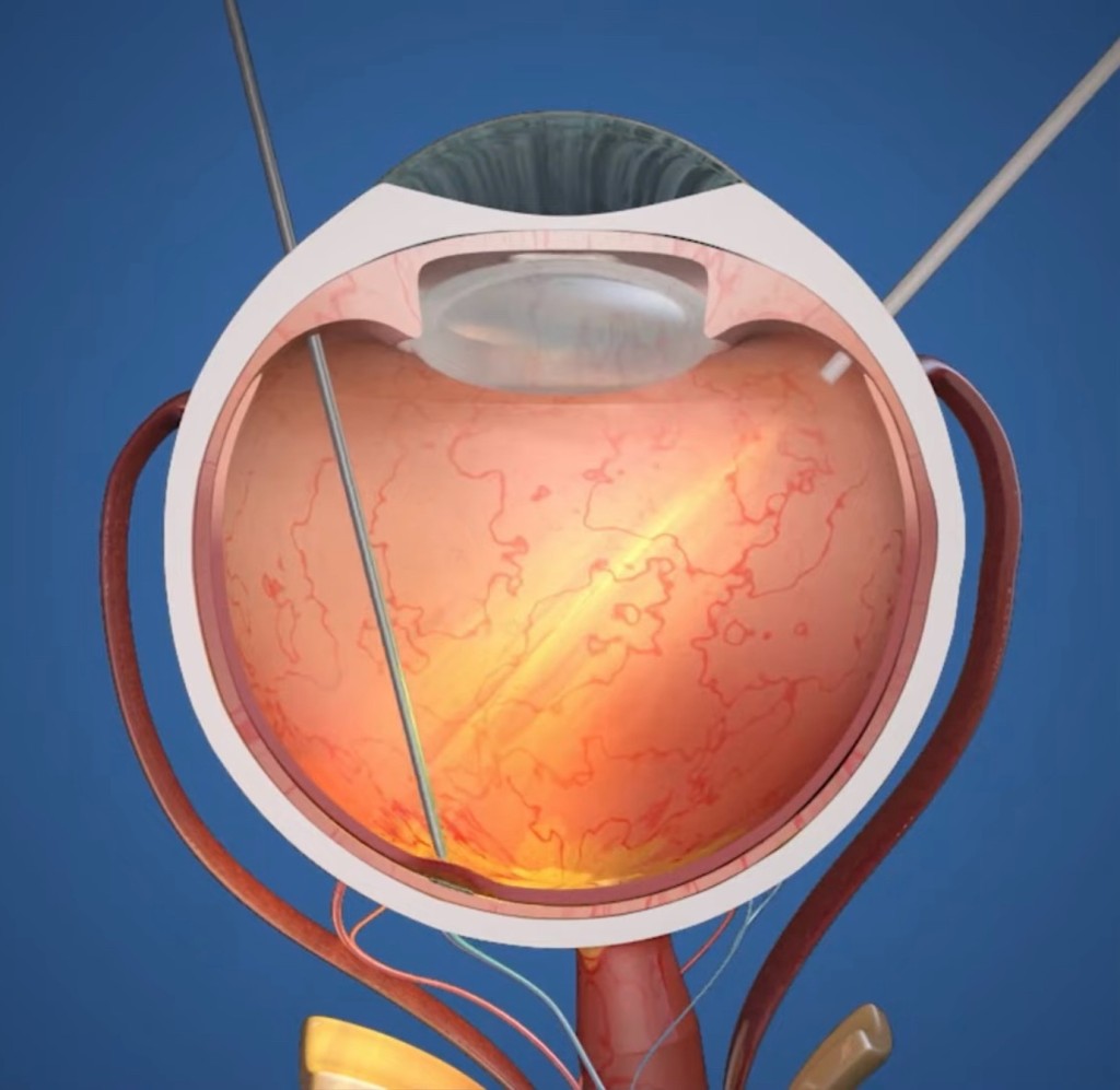 醫生透過玻璃體切除術植入微型裝置。  Moorfields Eye Hospital NHS Foundation Trust