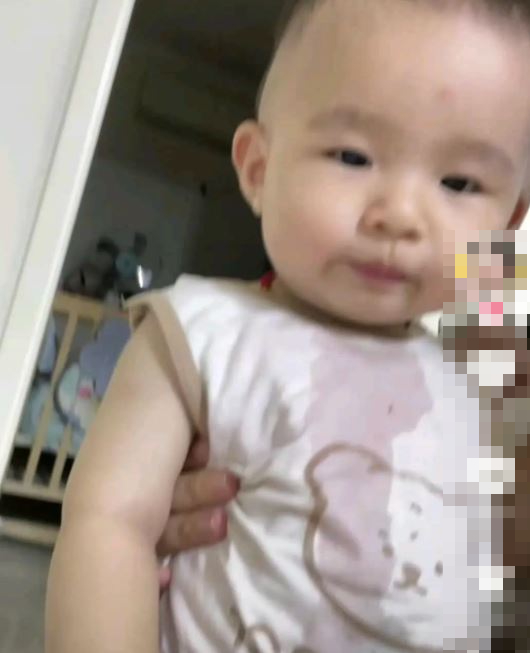 小孩在事故中嚴重被燙傷。抖音@王倩