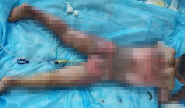 小雷爸不慎跌入滾燙油桶內嚴重燒傷。網圖