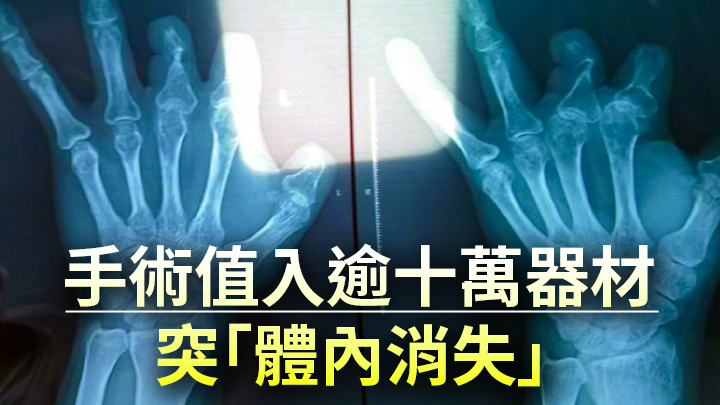 鄭州男子5年前接受手部手術,但X光片發現應當使用的貴價手術器材都「消失不見」。