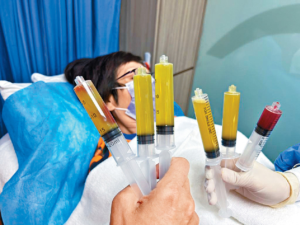 ■不少患者自覺膝部沒有積水問題，其實抽出來的積水份量可以很「驚人」。如任由積水積存不單影響盆骨、腰骨，更會導致頭暈、頭痛及加快關節退化。