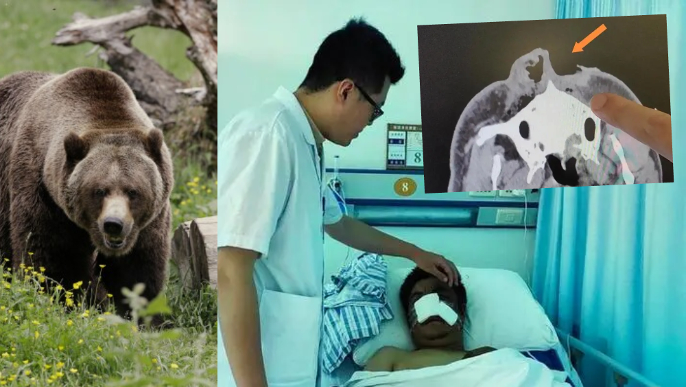 四川男子上山採菇遇熊出沒，被咬掉一半鼻子。