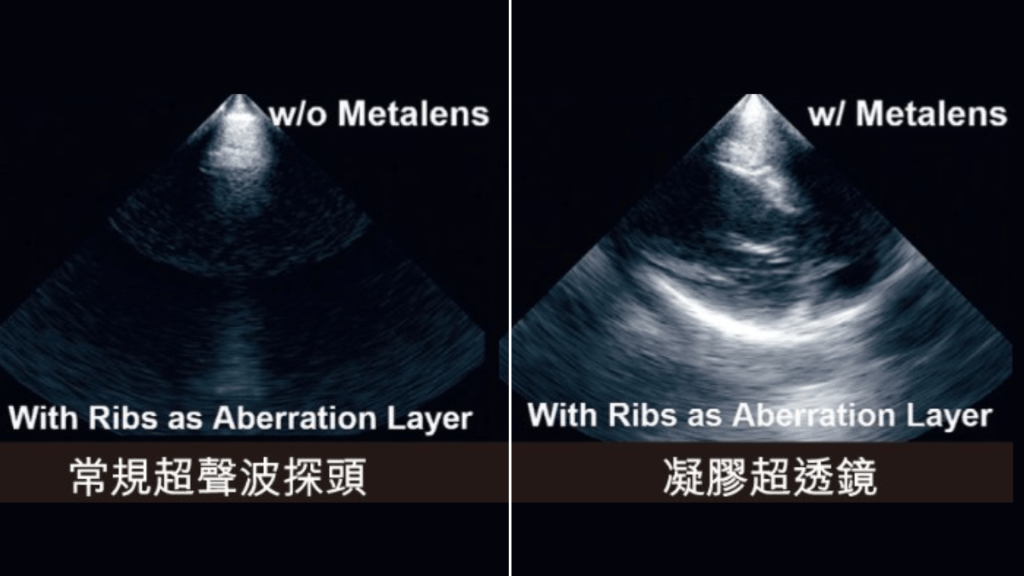 港大研發「動態超透鏡」 超聲波突破骨骼盲區 創心肺診斷革命性突破