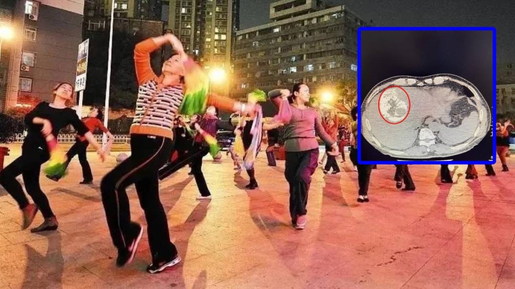 医生提醒有肝炎、肝硬化的民众，跳广场舞不宜过激及时间过长。示意图。新华社／潇湘晨报