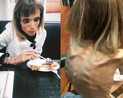 卡里亞金娜嚴重厭食，平曰只吃小片蘋果和香蕉，但經治療後終於開口食用其他食物。(網圖)