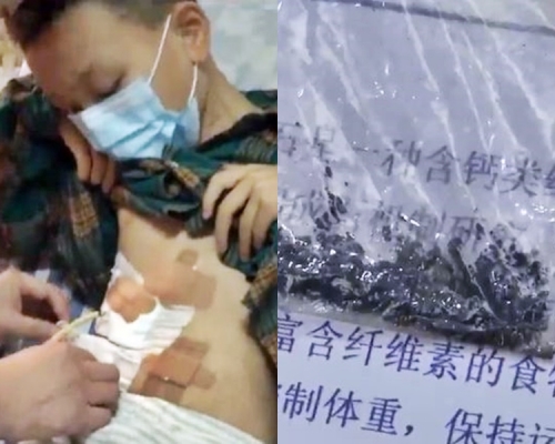 9歲男童患膽結石。網圖