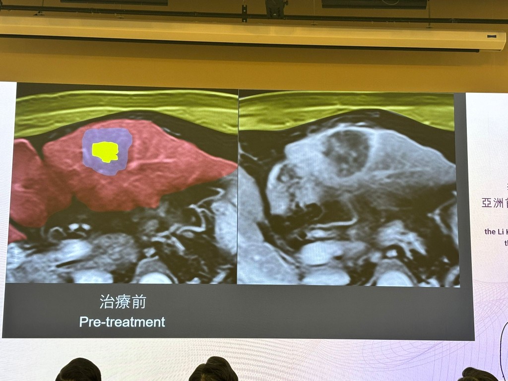 威爾斯親王醫院團隊將有30個治療名額,早前已完成一名肝癌患者治療。脫芷晴攝 威爾斯親王醫院團隊將有30個治療名額,早前已完成一名肝癌患者治療。脫芷晴攝