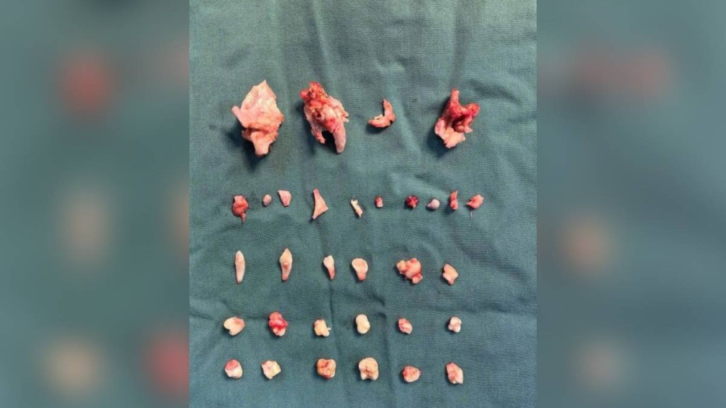 湖南少女腹中的卵巢畸胎瘤內藏24顆牙。瀟湘晨報