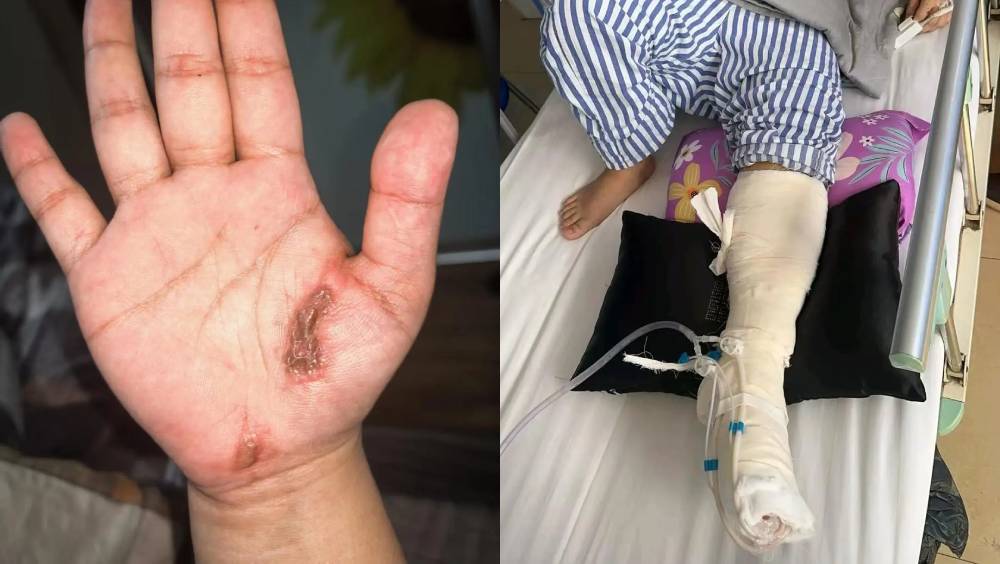 被电击女子手掌有明显电流入口造成的炭黑色焦痂。