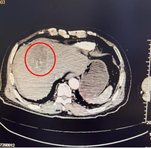 湖南有7旬妇跳广场舞太激裂，把肝肿瘤“跳爆”。潇湘晨报