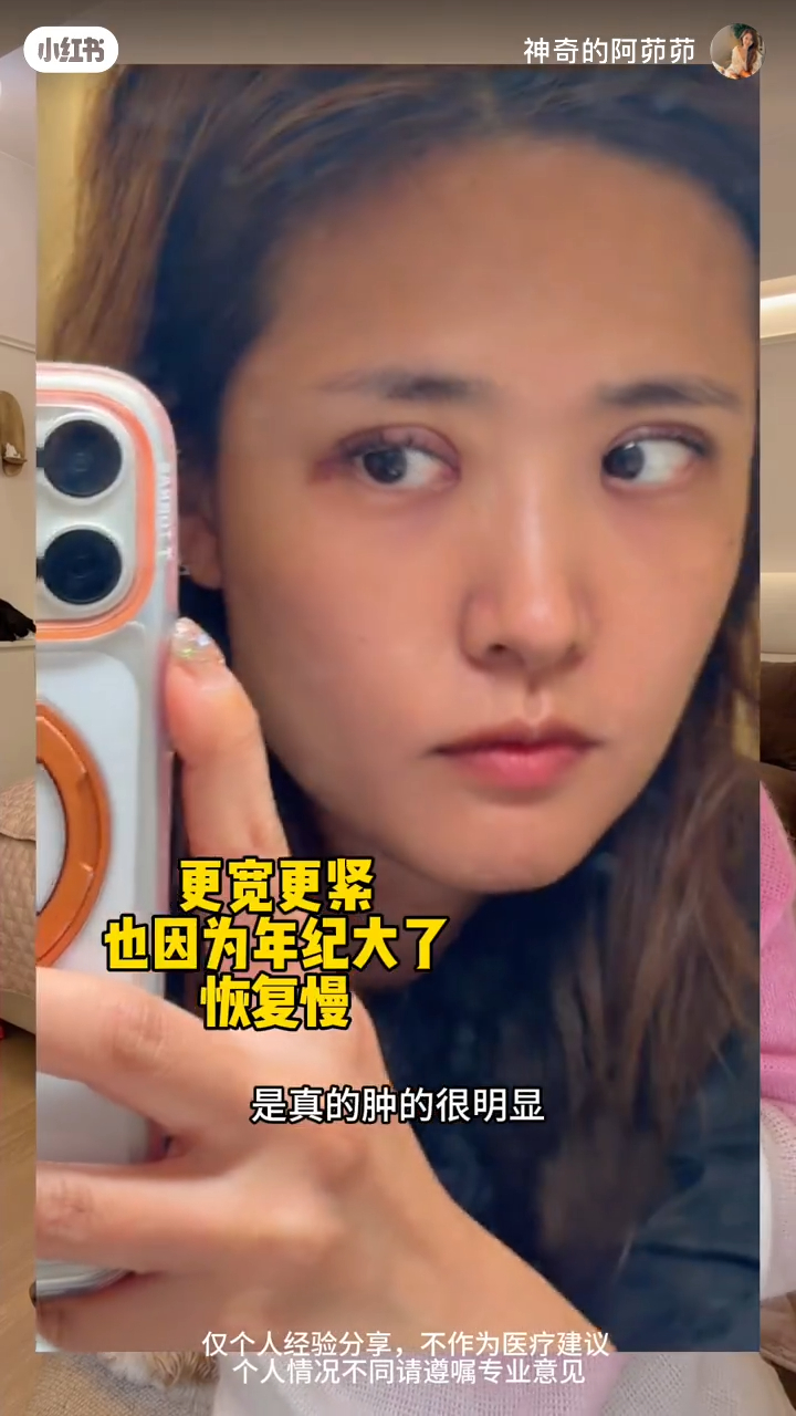 張茆手術後數天的恢復過程記錄，眼皮依然可見瘀青
