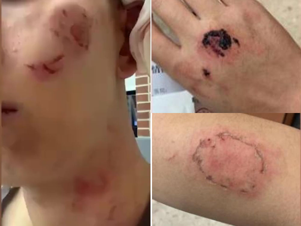 杭州男子遭陌生人咬傷。網圖