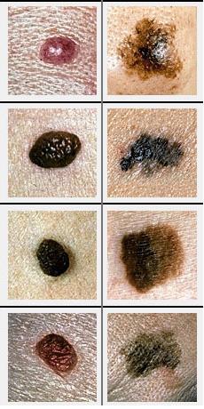 恶性黑色素瘤(右四图)会不对称、周界不明显、颜色不均，且多大于六毫米，与一般的痣(左四图)不同。 网上图片