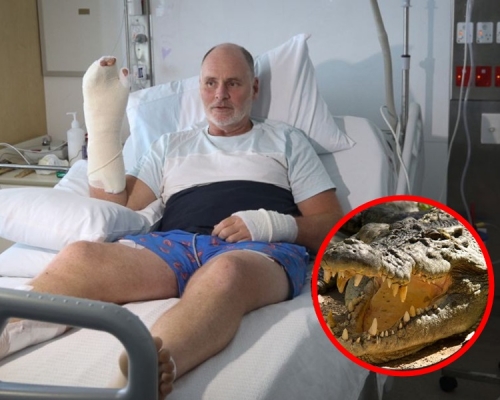 Dickmann手腳的皮膚在與鱷魚纏鬥過程中撕開。現時在凱恩斯醫院接受治療。網圖 