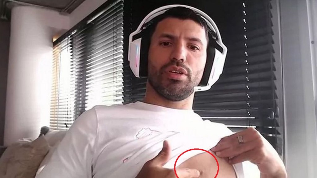 阿古路在社交媒体Twitch直播中，指着自己早前接受手术时镶了一块微型晶片(红圈)。网上图片