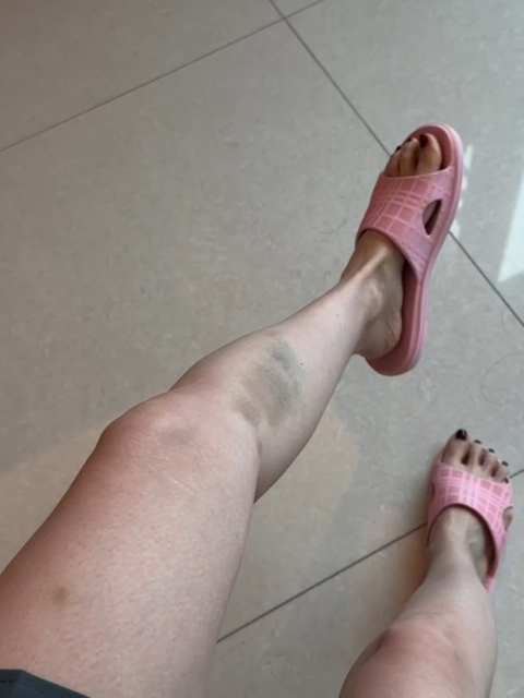 由陳若思提供的影片可見，她拍攝過後腿上有大片瘀傷。