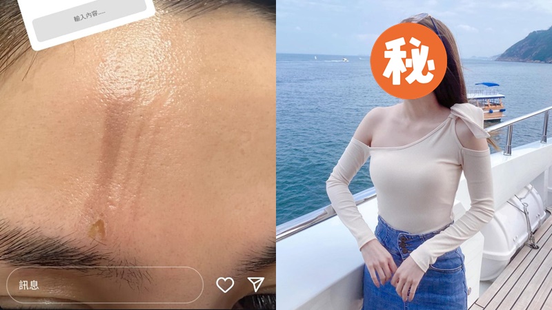 前《愛回家》女星遭電髮棒擲面恐毀容  神隱3個月低胸現身  曝光最新傷勢：已調整心態
