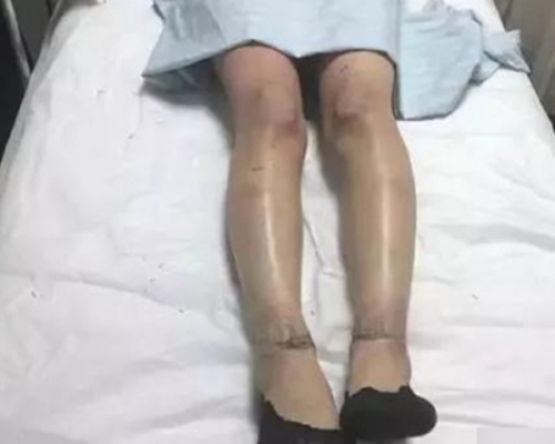 医生指，二人烧伤部位主要是四肢和面部、颈部等暴露在外没有衣物覆盖之处。 网图