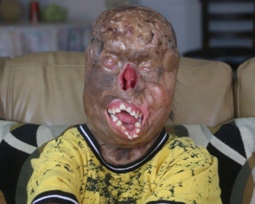 美國16歲少男賈西亞（Zaid Garcia），年幼時因一場火災，全身八成燒傷，更因此失明。（GoFundMe）