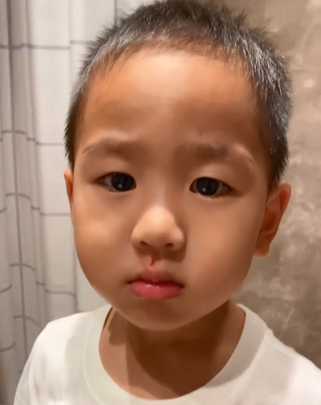 人中有一小道血痕。