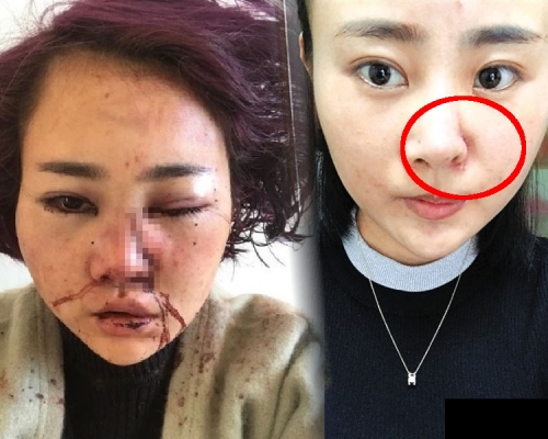 被打後第一次沒戴口罩出門，鼻旁還是有一條長長的疤痕。