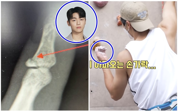 CNBLUE姜敏赫玩攀石唔小心整傷手指。